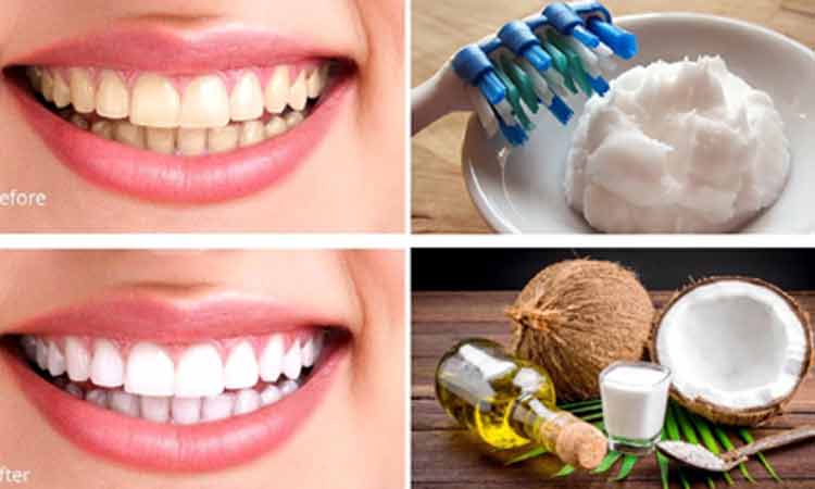 8-benefits-coconut-oil-teeth