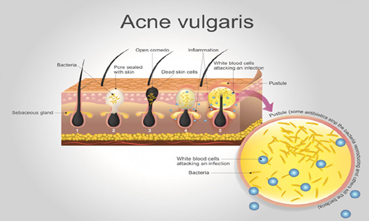 acne-vulgaris