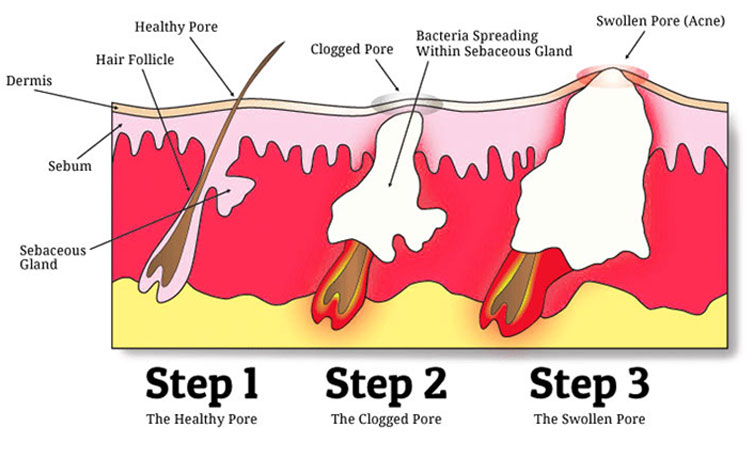 acne-development-vulgaris-scar