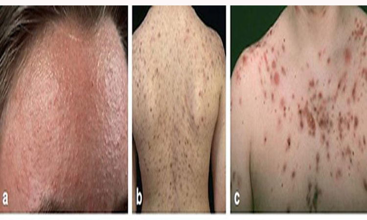 body-acne-vulgaris-scar