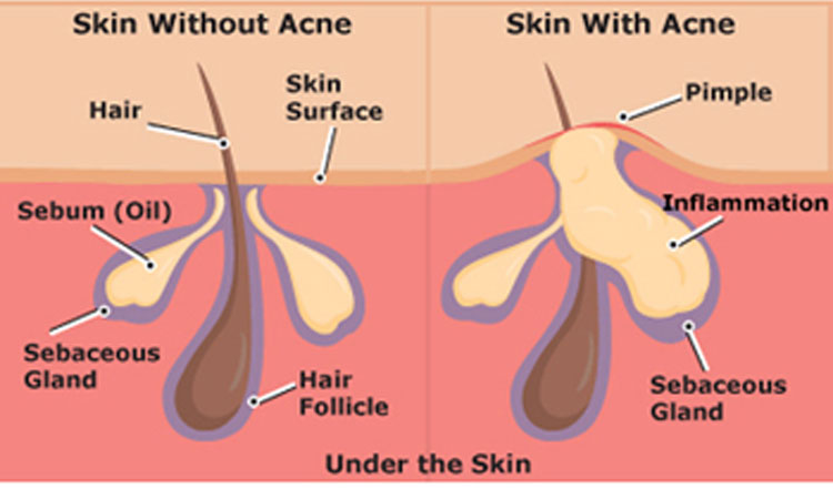 acne-cause-vulgaris-scar