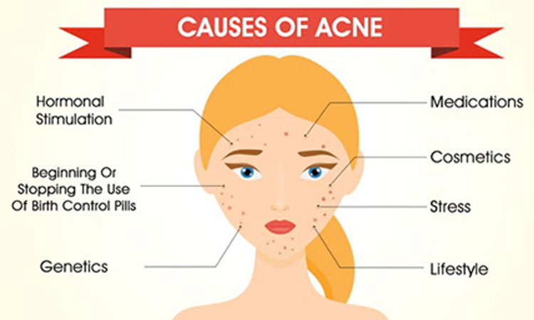 acne-cause-vulgaris-scar