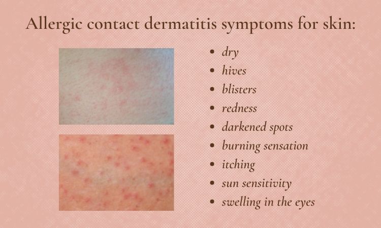 How To Treat Inflamed Skin And Contact Dermatitis Skin Beauty