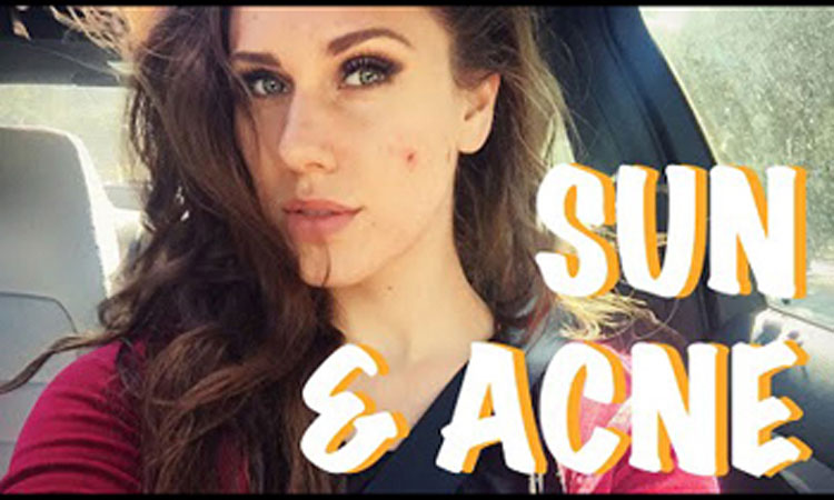 acne-sun-9-effective-steps
