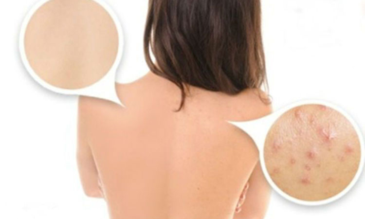 back-acne-9-effective-steps
