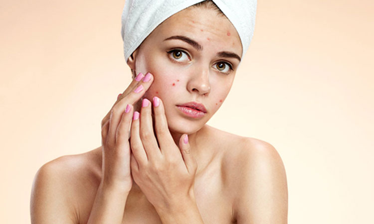 cleansing-acne-9-effective-steps