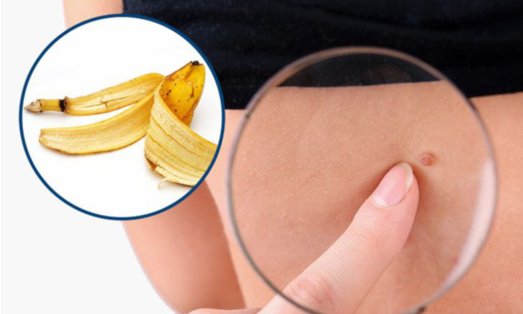 Banana peel to remove skin tags