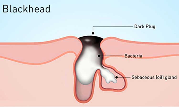 Eliminating Blackheads Acne