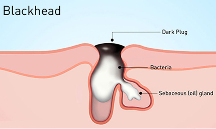 Blackhead Basics on At a moment in your life