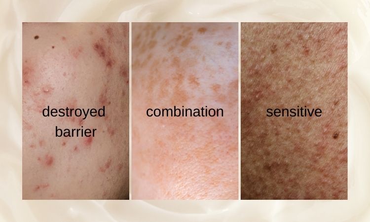 Acne prone shop sensitive skin
