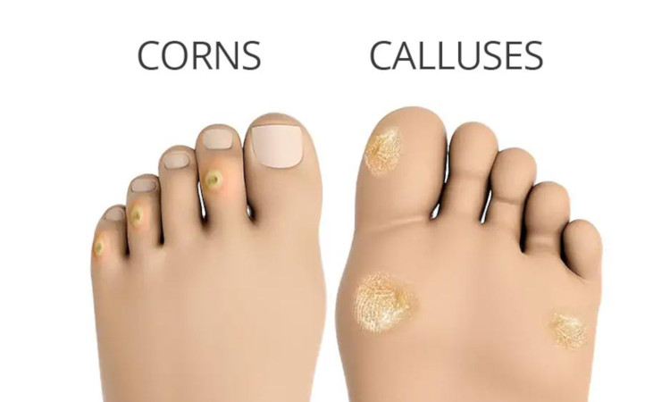 https://www.skin-beauty.com/product_images/uploaded_images/corns-calluses.jpg