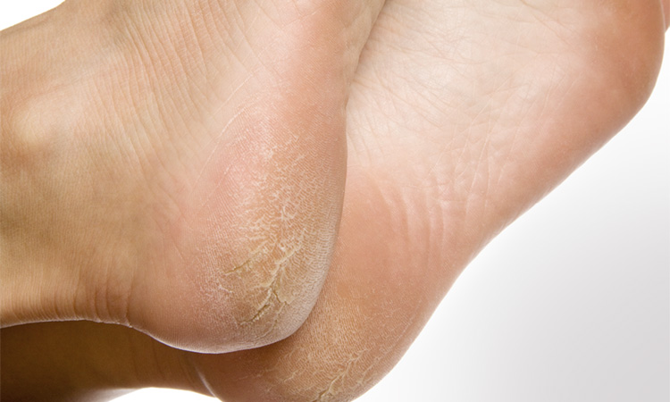 Typical Cracked Heels on 6 Methods To Eliminate Cracked Heels