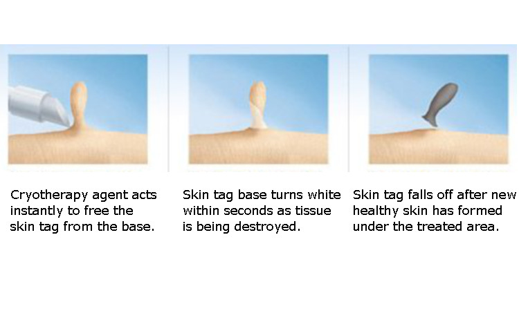 anal skin tag causes anal skin tag causes