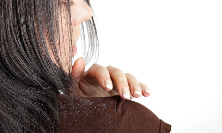 Dandruff on Benefits Of Rosehip Oil For Hair And Skin