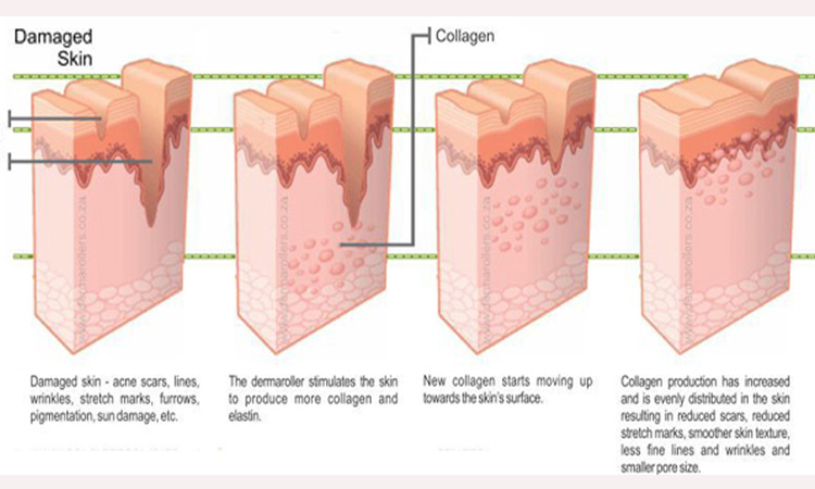 Collagen on Micro needles and Skin Rejuvenation