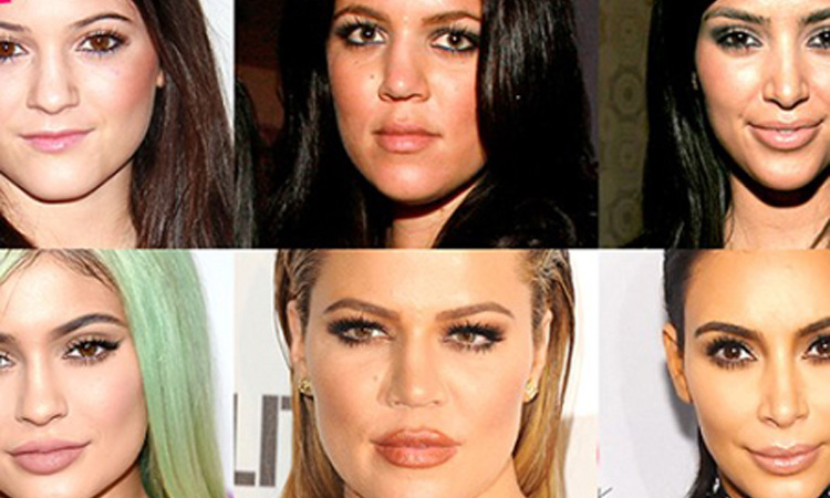 kardashians-lip-injection