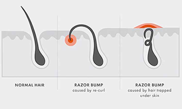 RazorBumps su 6 Home Rimedi Per Sbarazzarsi Di Rasoio Urti Veloce