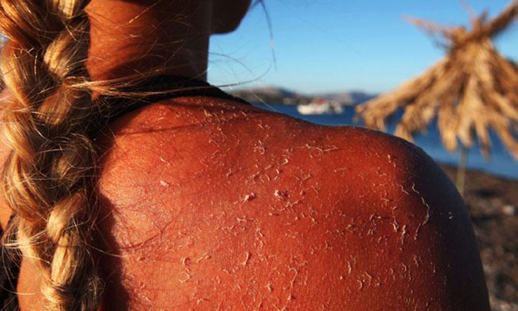 sunburn on 10 Effective Home Remedies To Treat Sunburn 