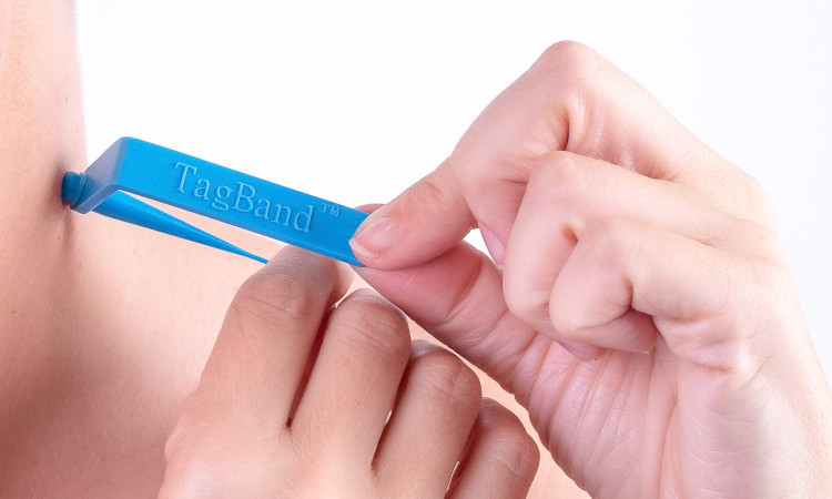 Tagband rubberband to remove skin tags
