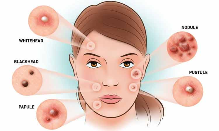 Acne on 5 Causes Of Blemishes On The Face