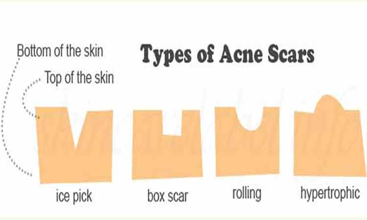 Type of Acne Scars on 5 Causes Of Blemishes On The Face