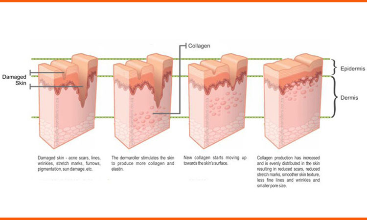 How it works on What Is A Dermaroller & What Are Its Benefits