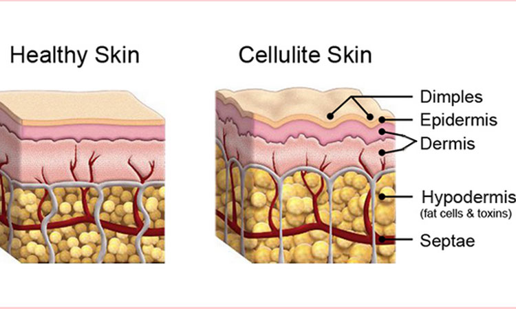 what is cellulite on How To Fight Cellulite In Simple And Effective Ways